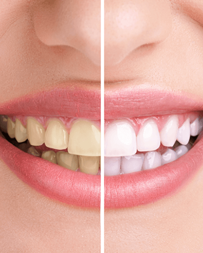 Teeth Whitening | Evershine Dental Care | Family & General Dentist | SE Calgary