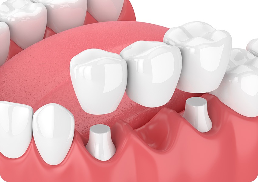 Dental Bridges | Evershine Dental Care | Family & General Dentist | SE Calgary