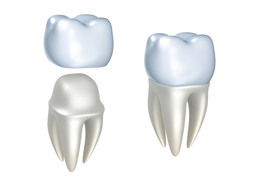Dental Crowns | Evershine Dental Care | Family & General Dentist | SE Calgary