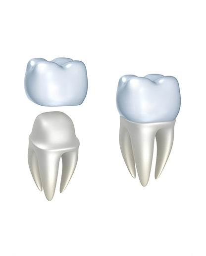 Dental Crowns | Evershine Dental Care | Family & General Dentist | SE Calgary