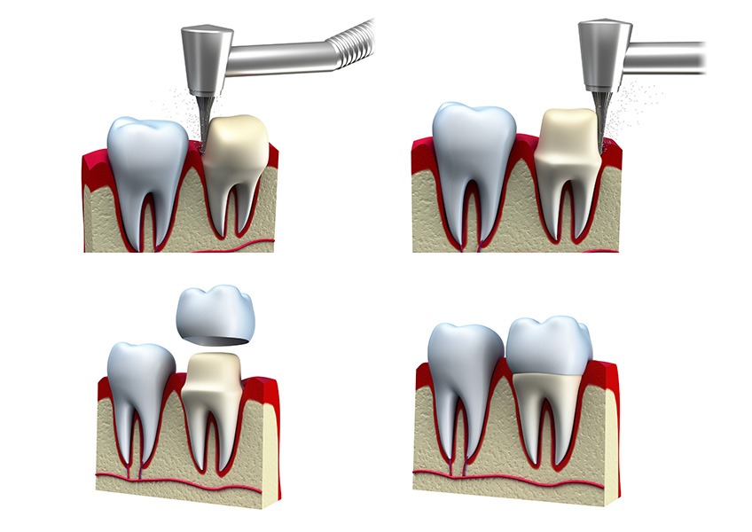Dental Crown Process | Evershine Dental Care | Family & General Dentist | SE Calgary