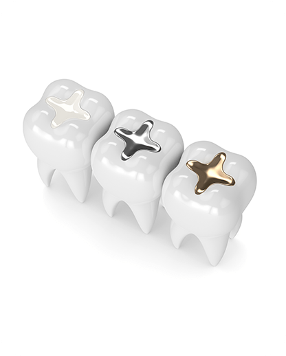 Dental Fillings | Evershine Dental Care | Family & General Dentist | SE Calgary