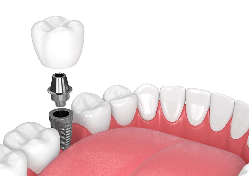 Dental Implant Crowns | Evershine Dental Care | Family & General Dentist | SE Calgary