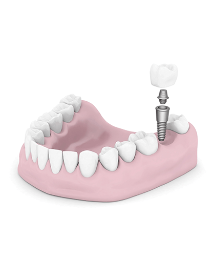 Dental Implant Crowns | Evershine Dental Care | Family & General Dentist | SE Calgary