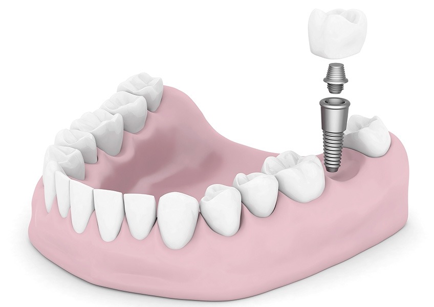 Dental Implant Crowns | Evershine Dental Care | Family & General Dentist | SE Calgary