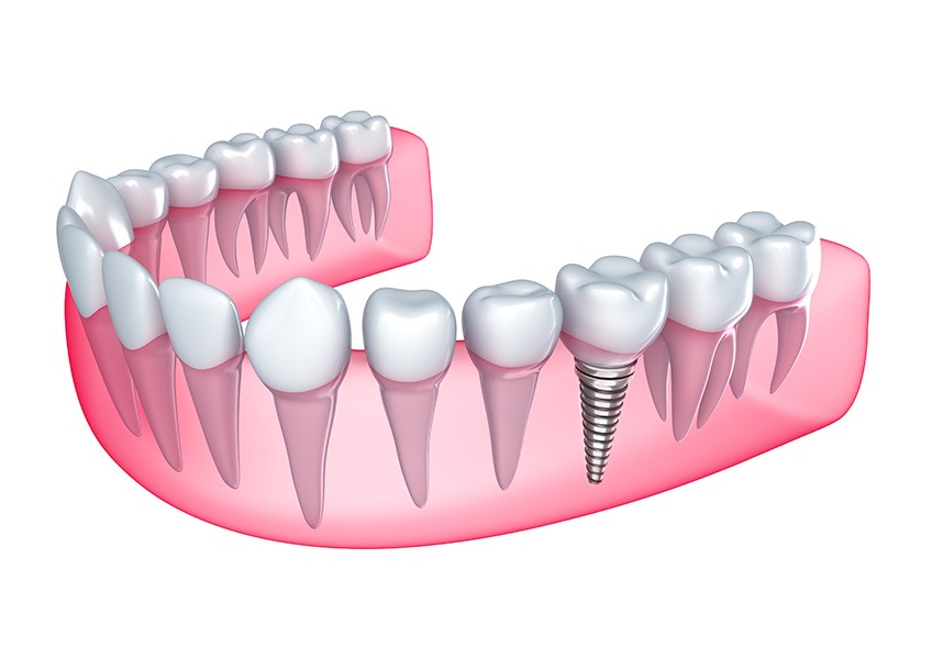Implant Dentistry | Evershine Dental Care | Family & General Dentist | SE Calgary