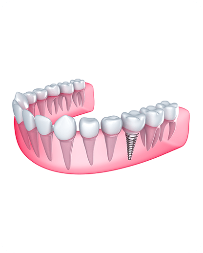 Implant Dentistry | Evershine Dental Care | Family & General Dentist | SE Calgary