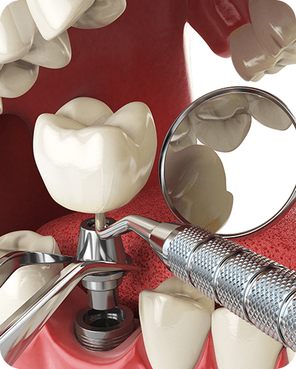 Implant Placement Surgery | Evershine Dental Care | Family & General Dentist | SE Calgary