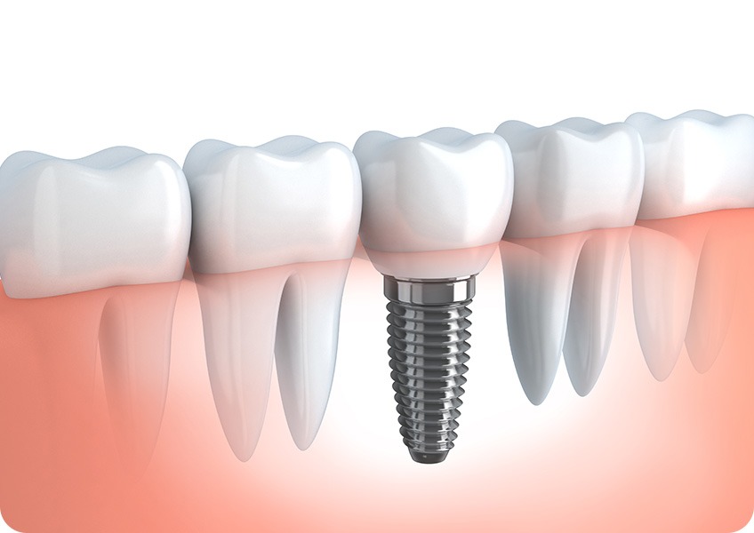 Implant Placement Surgery | Evershine Dental Care | Family & General Dentist | SE Calgary