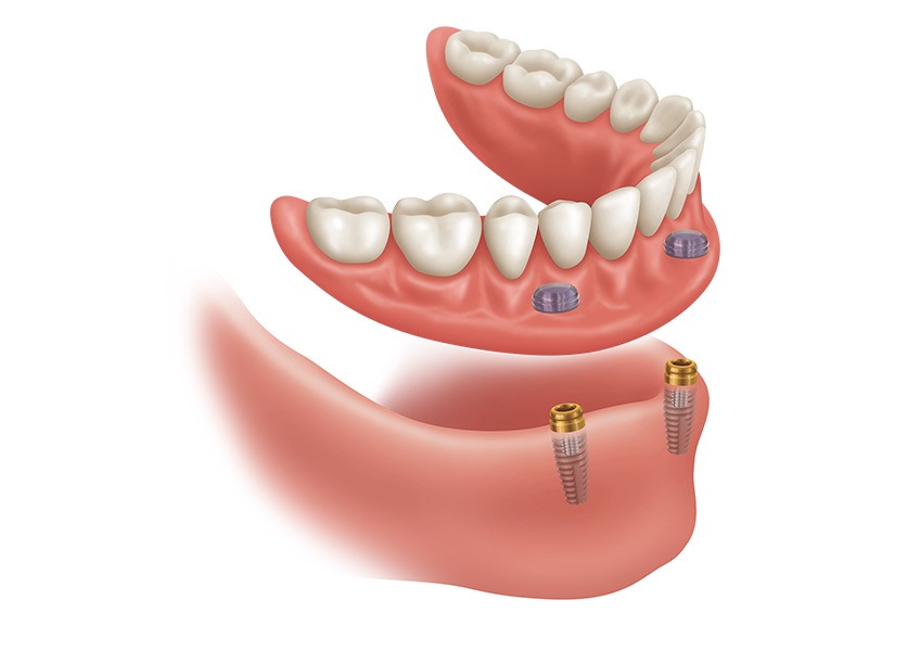 Implant Supported Dentures | Evershine Dental Care | Family & General Dentist | SE Calgary