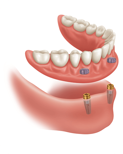 Implant Supported Dentures | Evershine Dental Care | Family & General Dentist | SE Calgary