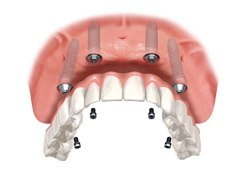 Implant Supported Dentures | Evershine Dental Care | Family & General Dentist | SE Calgary