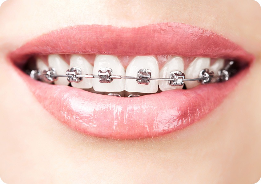 Metal Braces | Evershine Dental Care | Family & General Dentist | SE Calgary