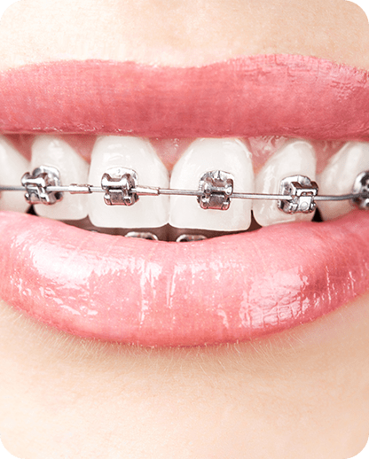 Metal Braces | Evershine Dental Care | Family & General Dentist | SE Calgary