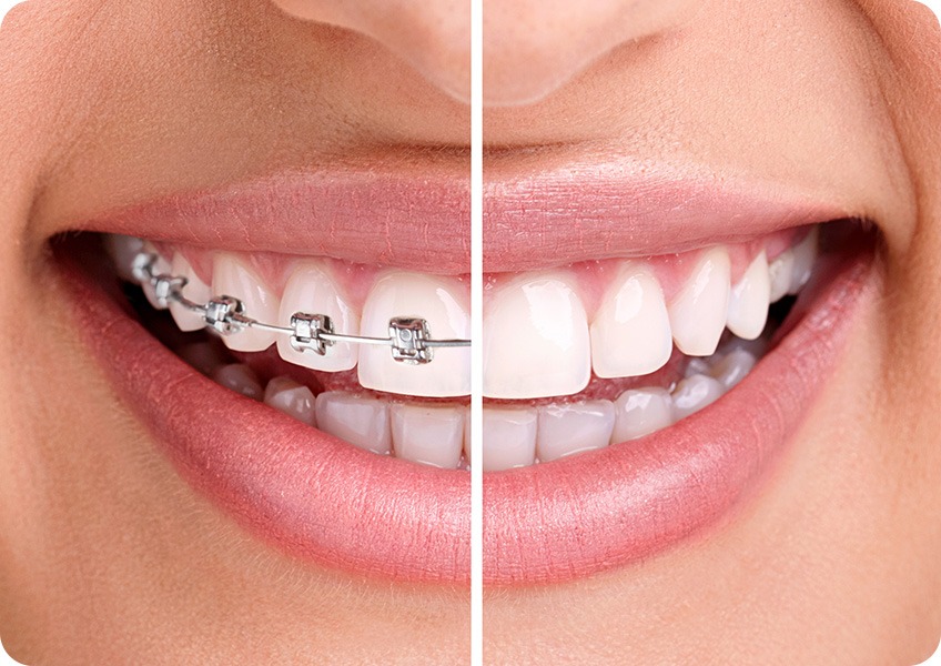 Metal Braces | Evershine Dental Care | Family & General Dentist | SE Calgary