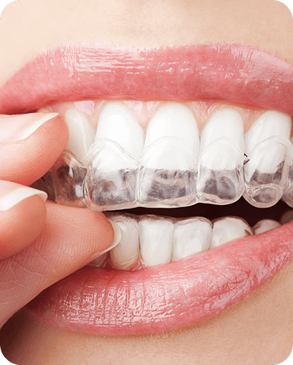 Orthodontics | Evershine Dental Care | Family & General Dentist | SE Calgary