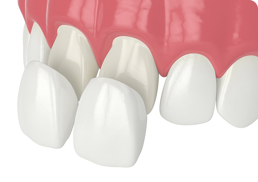Porcelain Veneers | Evershine Dental Care | Family & General Dentist | SE Calgary