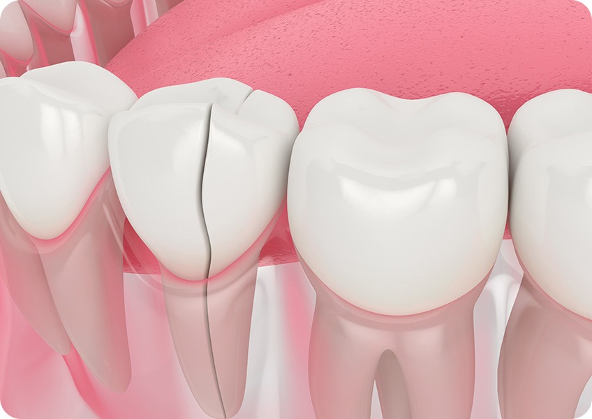 Restorative Dentistry | Evershine Dental Care | Family & General Dentist | SE Calgary