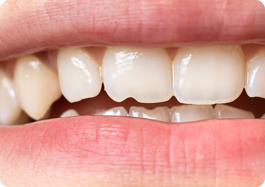 Restorative Dentistry | Evershine Dental Care | Family & General Dentist | SE Calgary