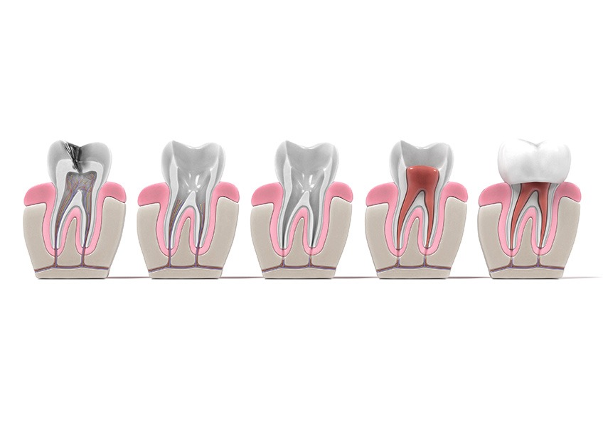 Root Canal Therapy | Evershine Dental Care | Family & General Dentist | SE Calgary