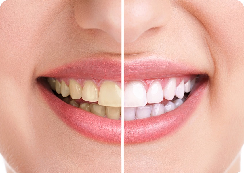 Teeth Whitening | Evershine Dental Care | Family & General Dentist | SE Calgary